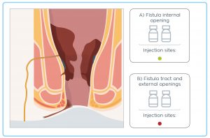 Alofisel -darvadstrocel - 4 flacons toediening