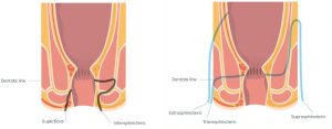 perianale fistels bij Crohn